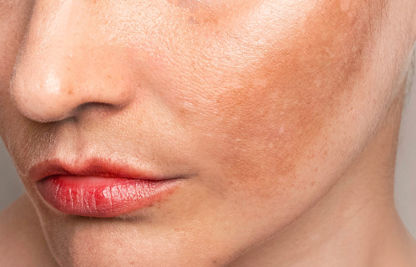 Trattamento del melasma: soluzioni dermatologiche personalizzate