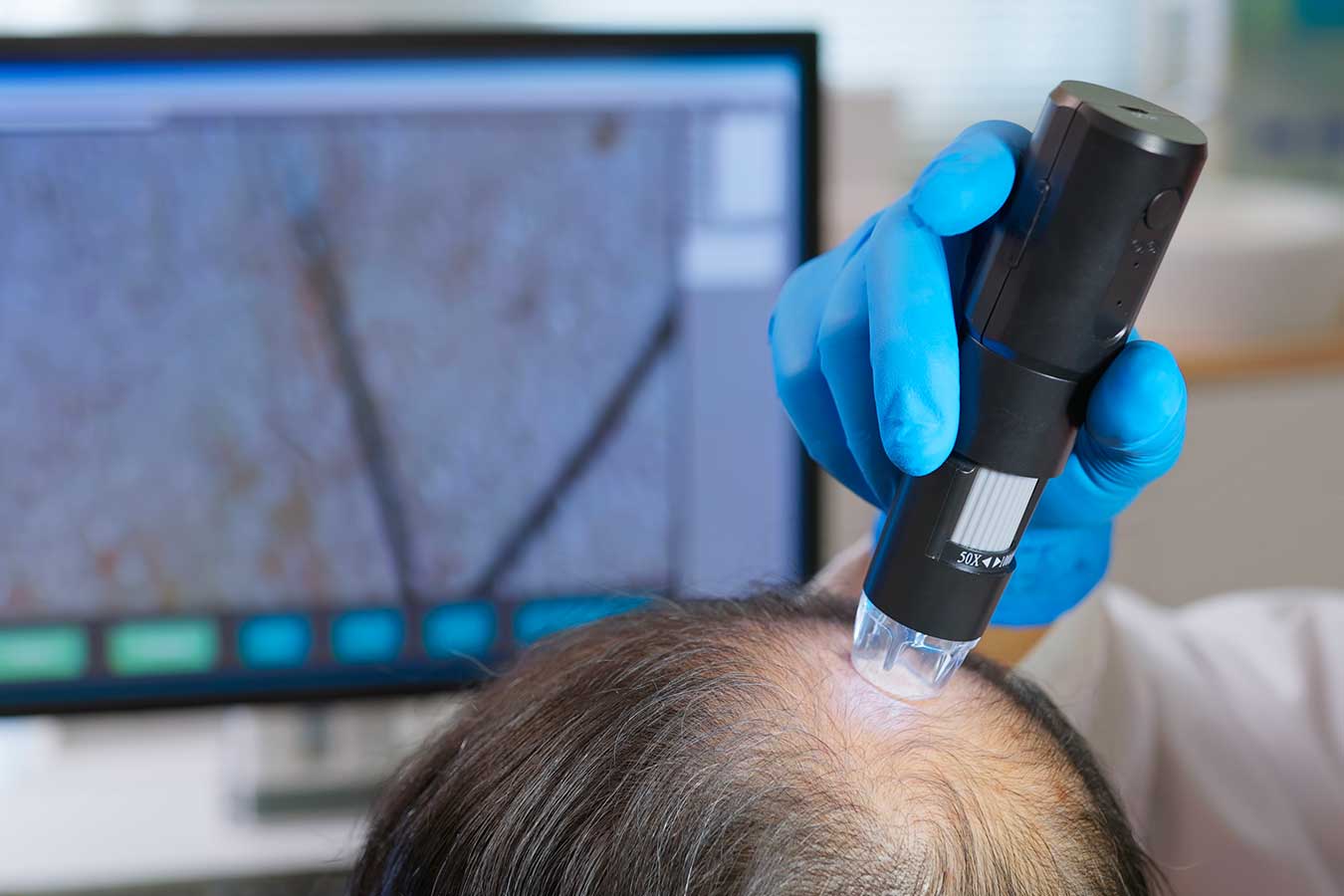 PRP biomimetico per il cuoio capelluto